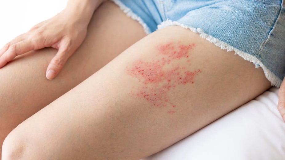 The Shingles Solution